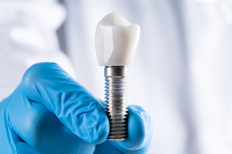 All-on-6 Dental Implants